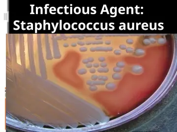 Slide 28: Infectious Agent: Staphylococcus aureus