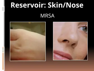 Slide 29: Reservoir: Skin/Nose