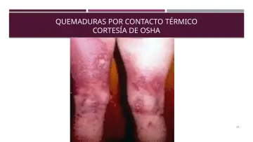 Slide 22: QUEMADURAS POR CONTACTO TÉRMICO