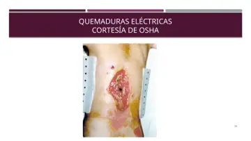 Slide 23: QUEMADURAS ELÉCTRICAS