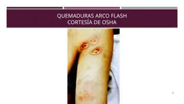 Slide 25: QUEMADURAS ARCO FLASH
