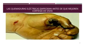 Slide 26: LAS QUEMADURAS ELÉCTRICAS EMPEORAN ANTES DE QUE MEJOREN