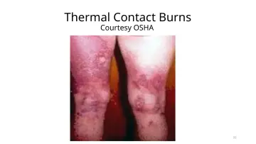 Slide 22: Thermal Contact Burns