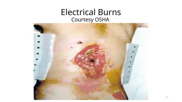 Slide 23: Electrical Burns