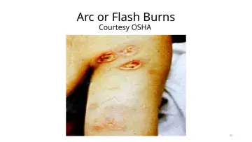 Slide 25: Arc or Flash Burns