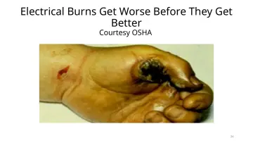 Slide 26: Electrical Burns Get Worse Before They Get