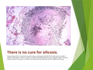 Slide 62: There is no cure for silicosis.