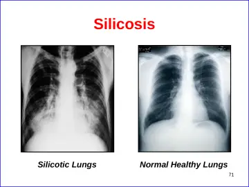 Slide 71: Silicosis