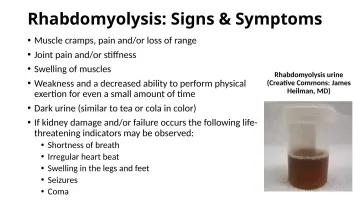 Slide 54: Rhabdomyolysis: Signs & Symptoms
