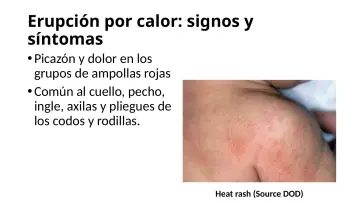 Slide 34: Erupción por calor: signos y síntomas