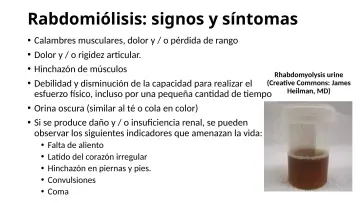 Slide 58: Rabdomiólisis: signos y síntomas