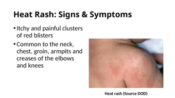 Slide 35: Heat Rash: Signs & Symptoms