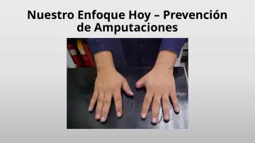 Slide 10: Nuestro Enfoque Hoy – Prevención de Amputaciones
