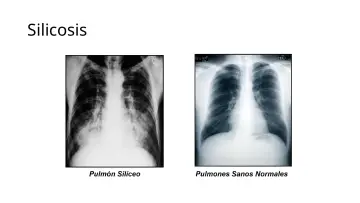 Slide 7: Silicosis