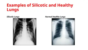 Slide 7: Examples of Silicotic and Healthy Lungs