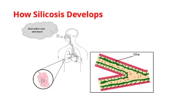 Slide 10: How Silicosis Develops