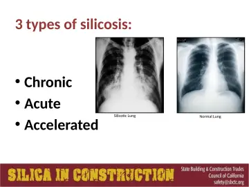 Slide 50: 3 types of silicosis: